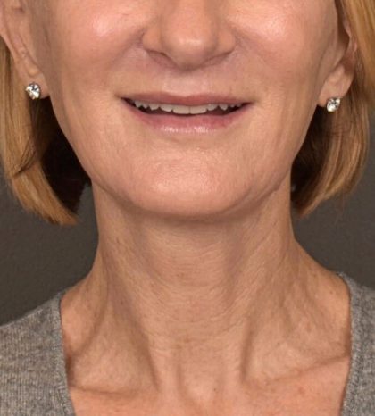 Neck Lift Before & After Patient #3459