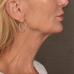 Neck Lift Before & After Patient #3459