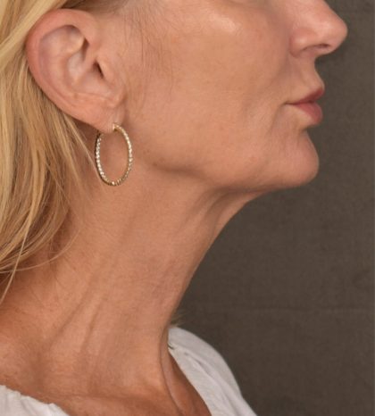Neck Lift Before & After Patient #3459