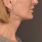 Neck Lift Before & After Patient #3459