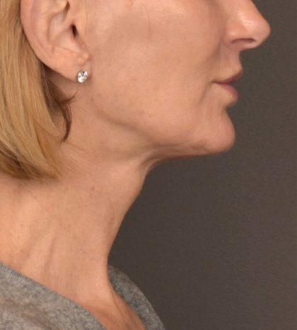 Neck Lift Before & After Patient #3459