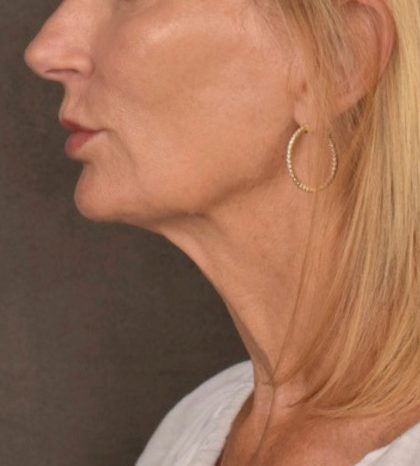 Neck Lift Before & After Patient #3459