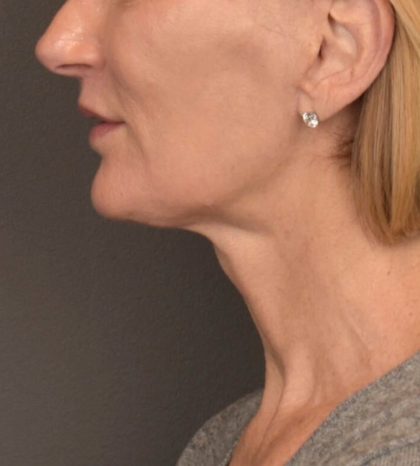 Neck Lift Before & After Patient #3459