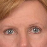Brow Lift Before & After Patient #3462