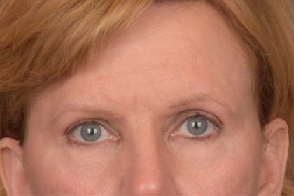 Brow Lift Before & After Patient #3462