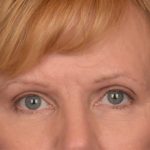 Brow Lift Before & After Patient #3462