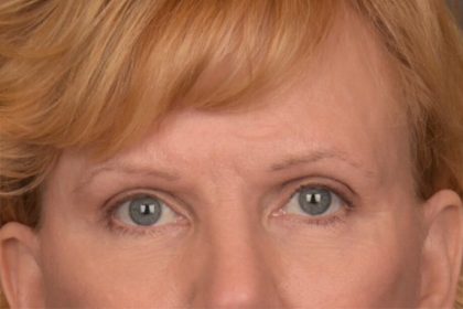 Brow Lift Before & After Patient #3462