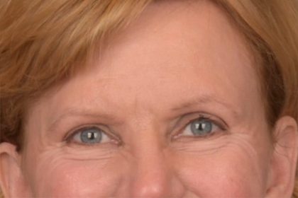 Brow Lift Before & After Patient #3462