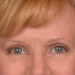 Brow Lift Before & After Patient #3462