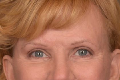 Brow Lift Before & After Patient #3462
