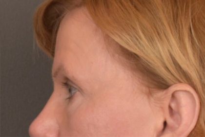 Brow Lift Before & After Patient #3462