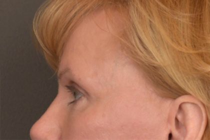 Brow Lift Before & After Patient #3462