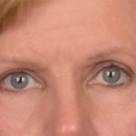 Blepharoplasty Before & After Patient #3463