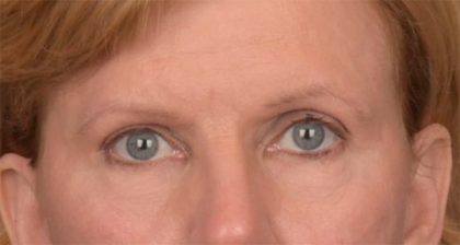 Blepharoplasty Before & After Patient #3463