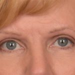 Blepharoplasty Before & After Patient #3463