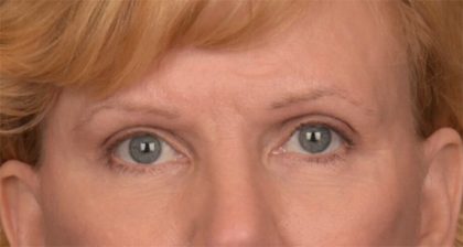 Blepharoplasty Before & After Patient #3463