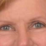 Blepharoplasty Before & After Patient #3463