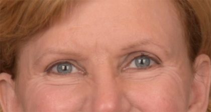 Blepharoplasty Before & After Patient #3463