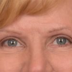 Blepharoplasty Before & After Patient #3463