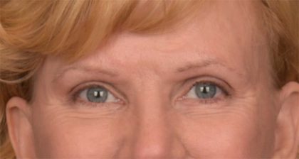 Blepharoplasty Before & After Patient #3463