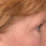 Blepharoplasty Before & After Patient #3463