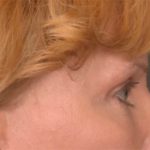 Blepharoplasty Before & After Patient #3463