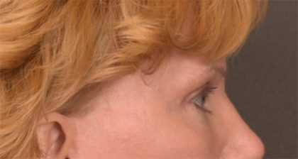 Blepharoplasty Before & After Patient #3463