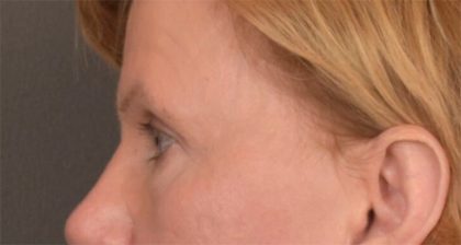 Blepharoplasty Before & After Patient #3463