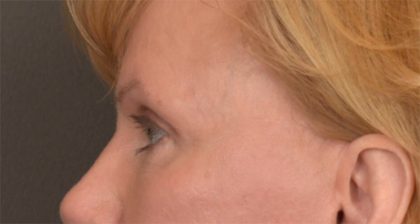 Blepharoplasty Before & After Patient #3463