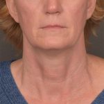 Neck Lift Before & After Patient #3465