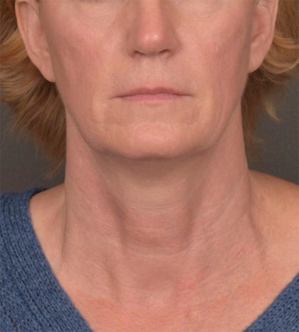 Neck Lift Before & After Patient #3465