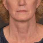 Neck Lift Before & After Patient #3465