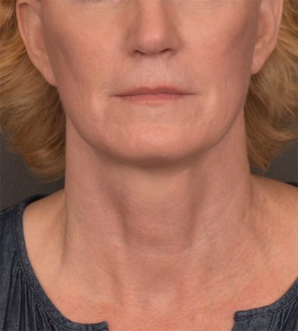 Neck Lift Before & After Patient #3465