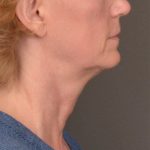Neck Lift Before & After Patient #3465