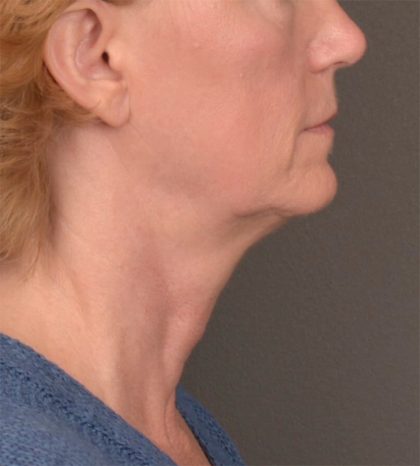 Neck Lift Before & After Patient #3465