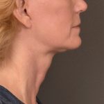 Neck Lift Before & After Patient #3465