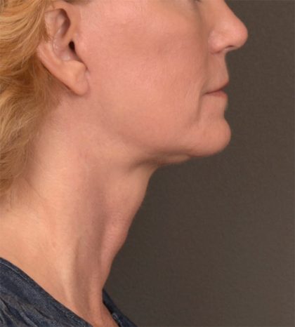 Neck Lift Before & After Patient #3465