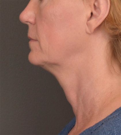 Neck Lift Before & After Patient #3465