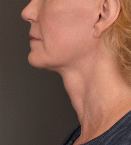 Neck Lift Before & After Patient #3465