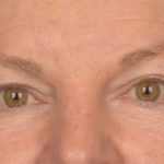 Blepharoplasty Before & After Patient #3468