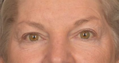 Blepharoplasty Before & After Patient #3468
