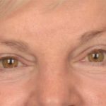 Blepharoplasty Before & After Patient #3468