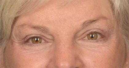 Blepharoplasty Before & After Patient #3468