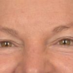 Blepharoplasty Before & After Patient #3468