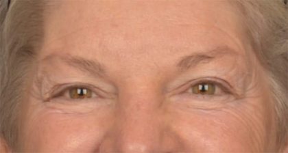 Blepharoplasty Before & After Patient #3468