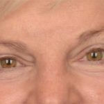 Blepharoplasty Before & After Patient #3468
