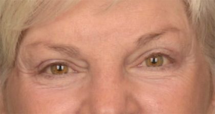 Blepharoplasty Before & After Patient #3468