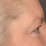 Blepharoplasty Before & After Patient #3468