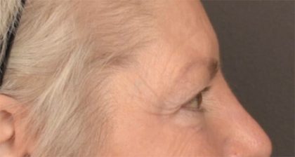 Blepharoplasty Before & After Patient #3468