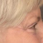 Blepharoplasty Before & After Patient #3468